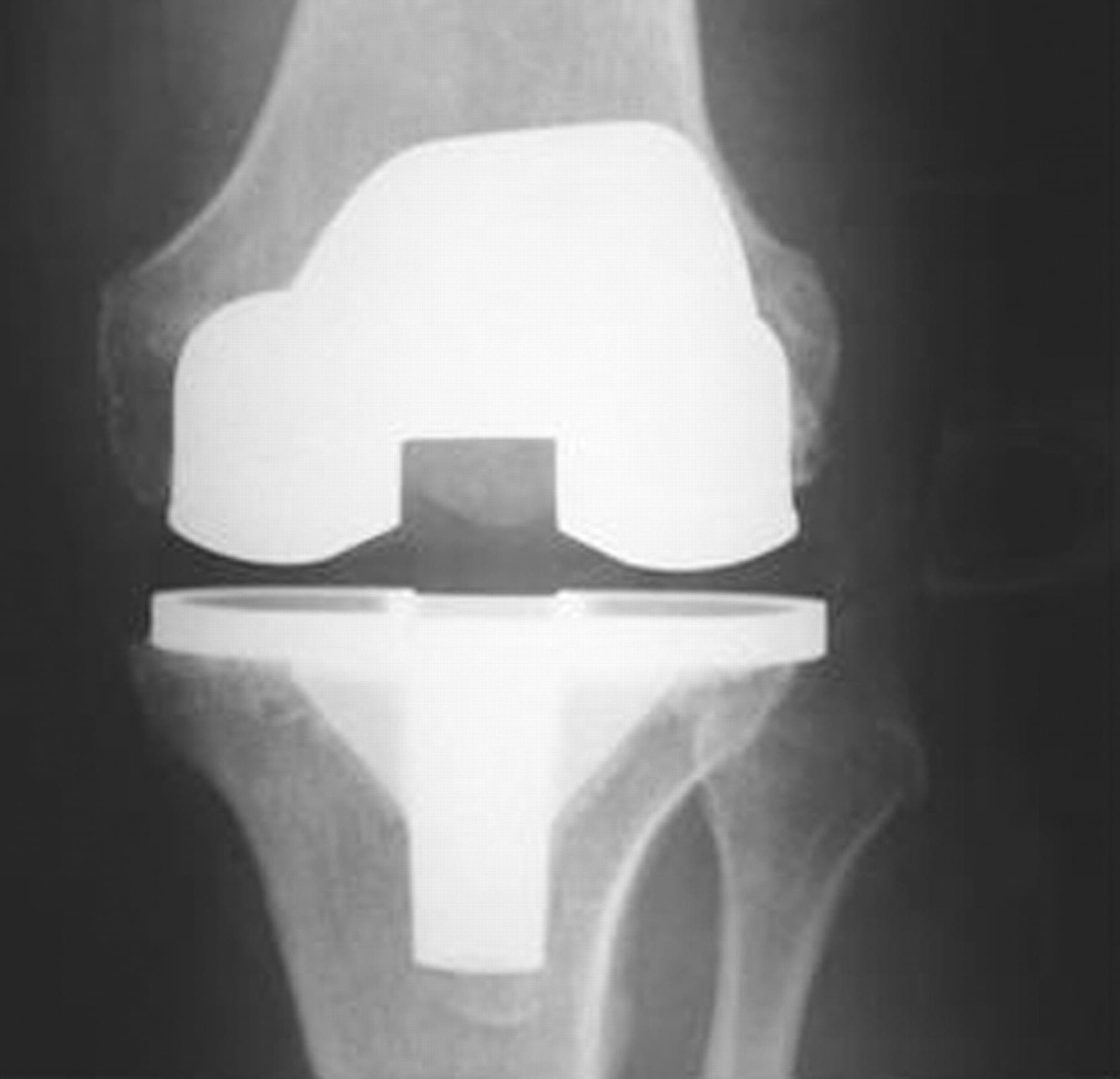 The orthopaedic approach to managing osteoarthritis of the knee