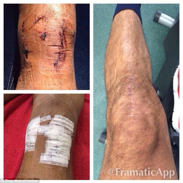 Theo Walcott shows pictures of knee injury on Twitter