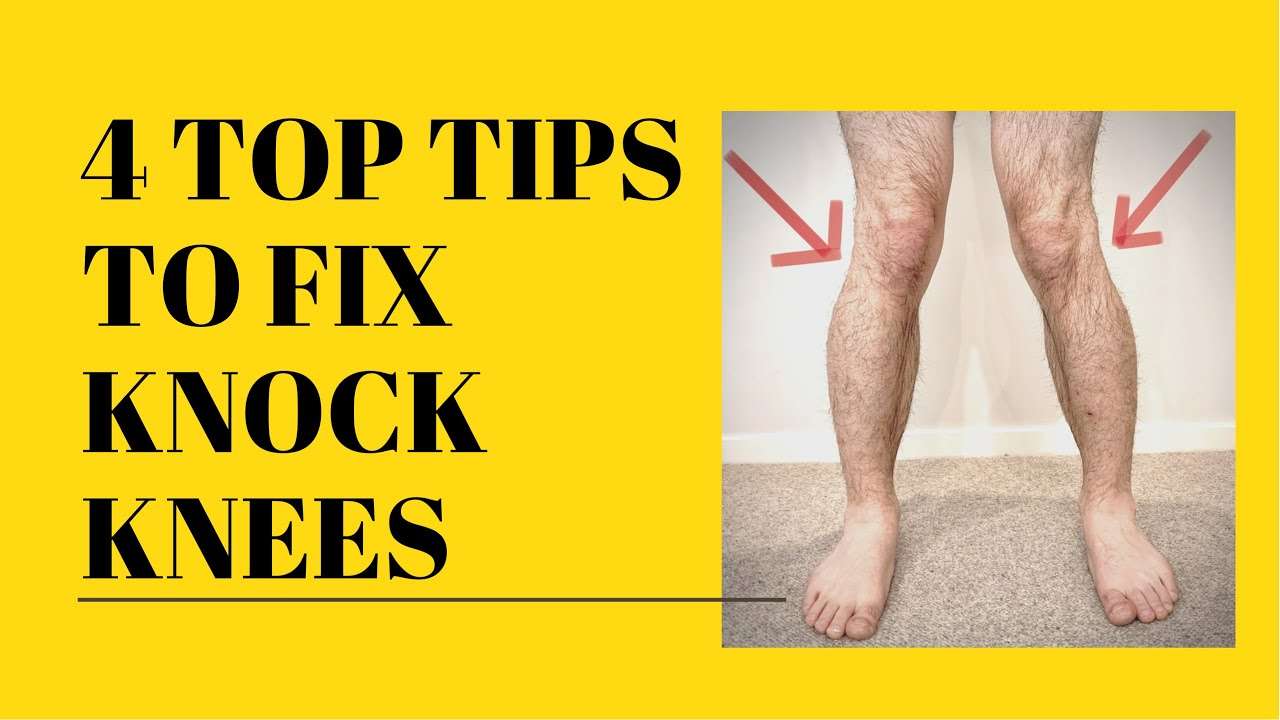 TOP TIPS TO FIX KNOCK KNEES WITHOUT SURGERY