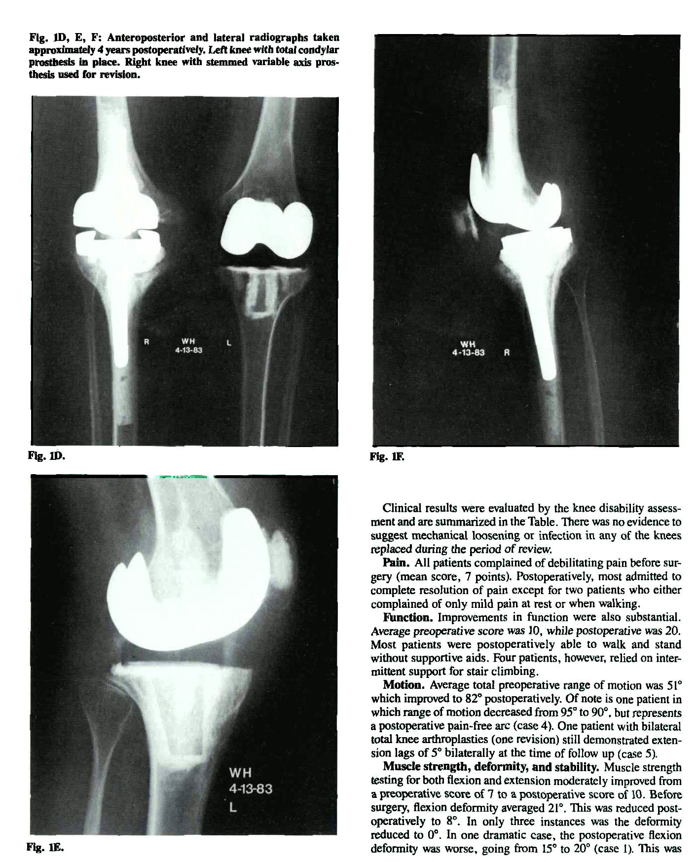 Total Knee Arthroplasty in Chronic Hemophilic Arthropathy