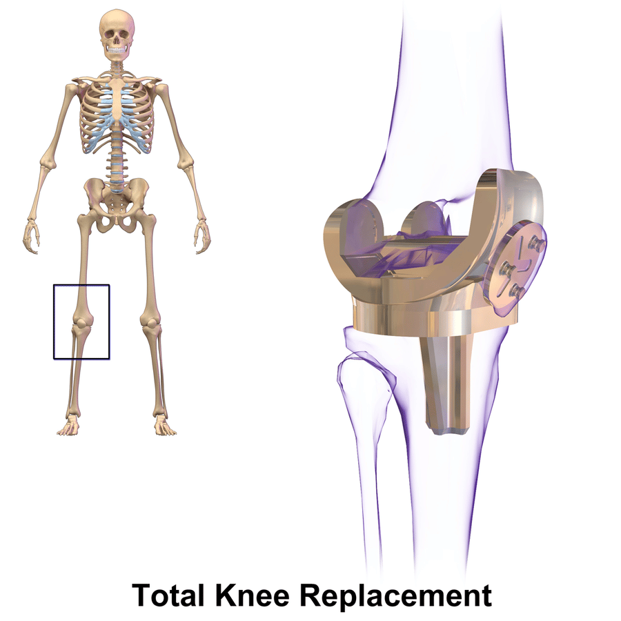 Total Knee Replacement Claims: Car and Motorcycle Accidents, Falls, Etc.