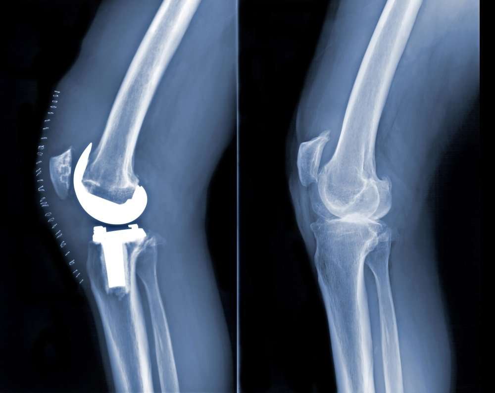 Total Knee Replacement for Osteoarthritis: Benefits and ...