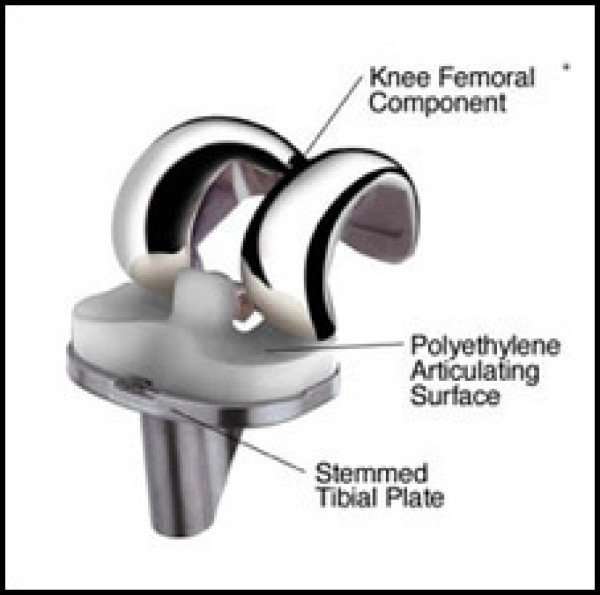 Total Knee Replacement implant.