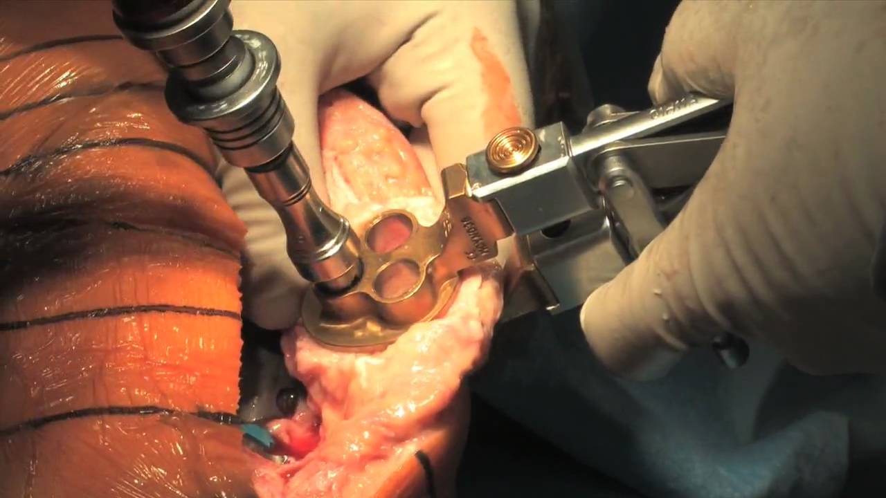 Total Knee Replacement Part 2: The Surgical Procedure ...