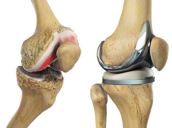 Total Knee Replacement Recovery: What To Expect