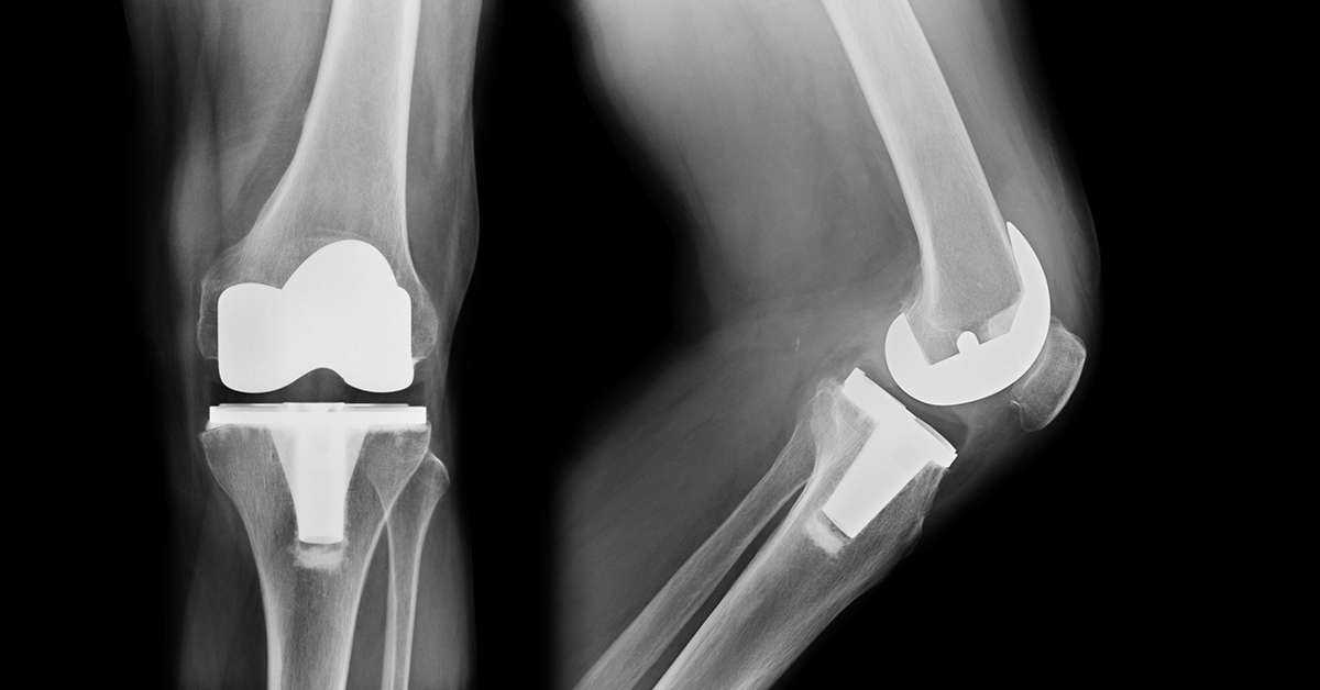 Total Knee Replacement Revision Surgery