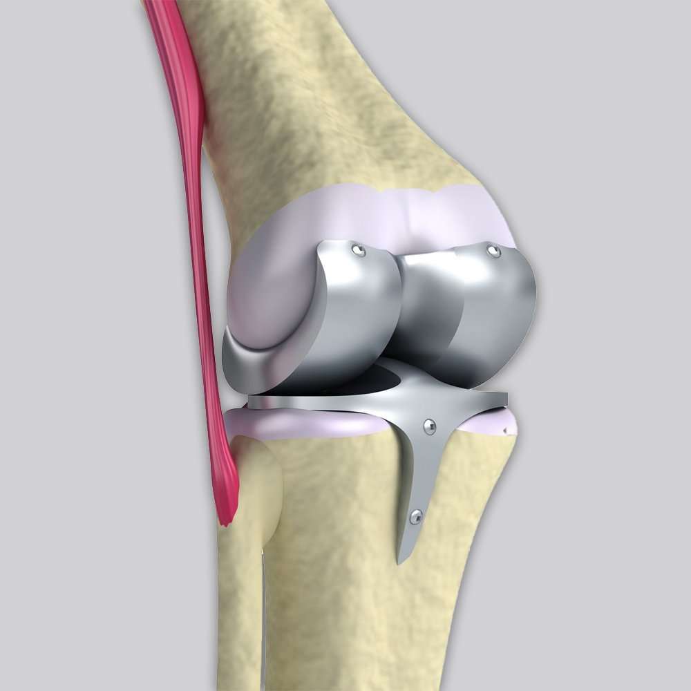 Total Knee Replacement Surgery Expert with Highest success ...