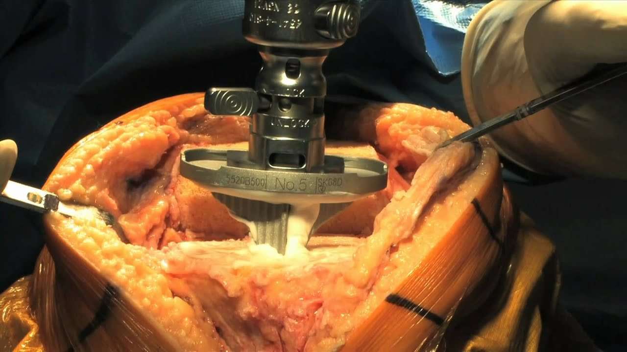Total Knee Replacement Surgery Part 2