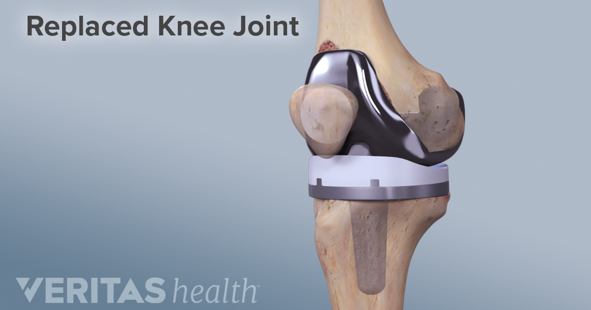 Total Knee Replacement Surgery Recovery