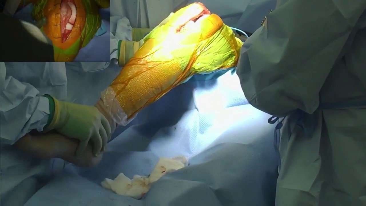 Total Knee Replacement Surgery Video