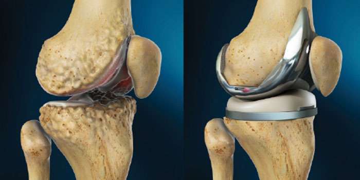 Total knee replacement treatment in Thane