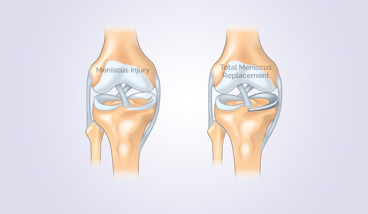 Total Meniscus Replacement for the Knee