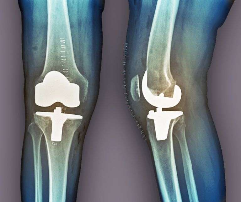 Total vs. Partial Knee Replacement