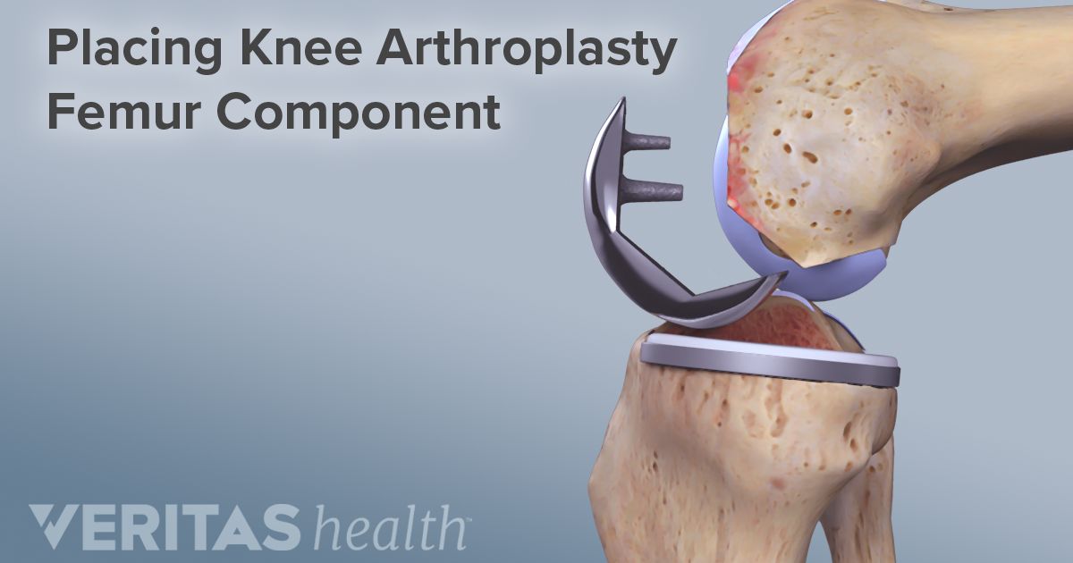 Traditional Knee Replacement vs. Minimally Invasive Knee ...