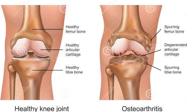 Treatment For Osteoarthritis (OA)