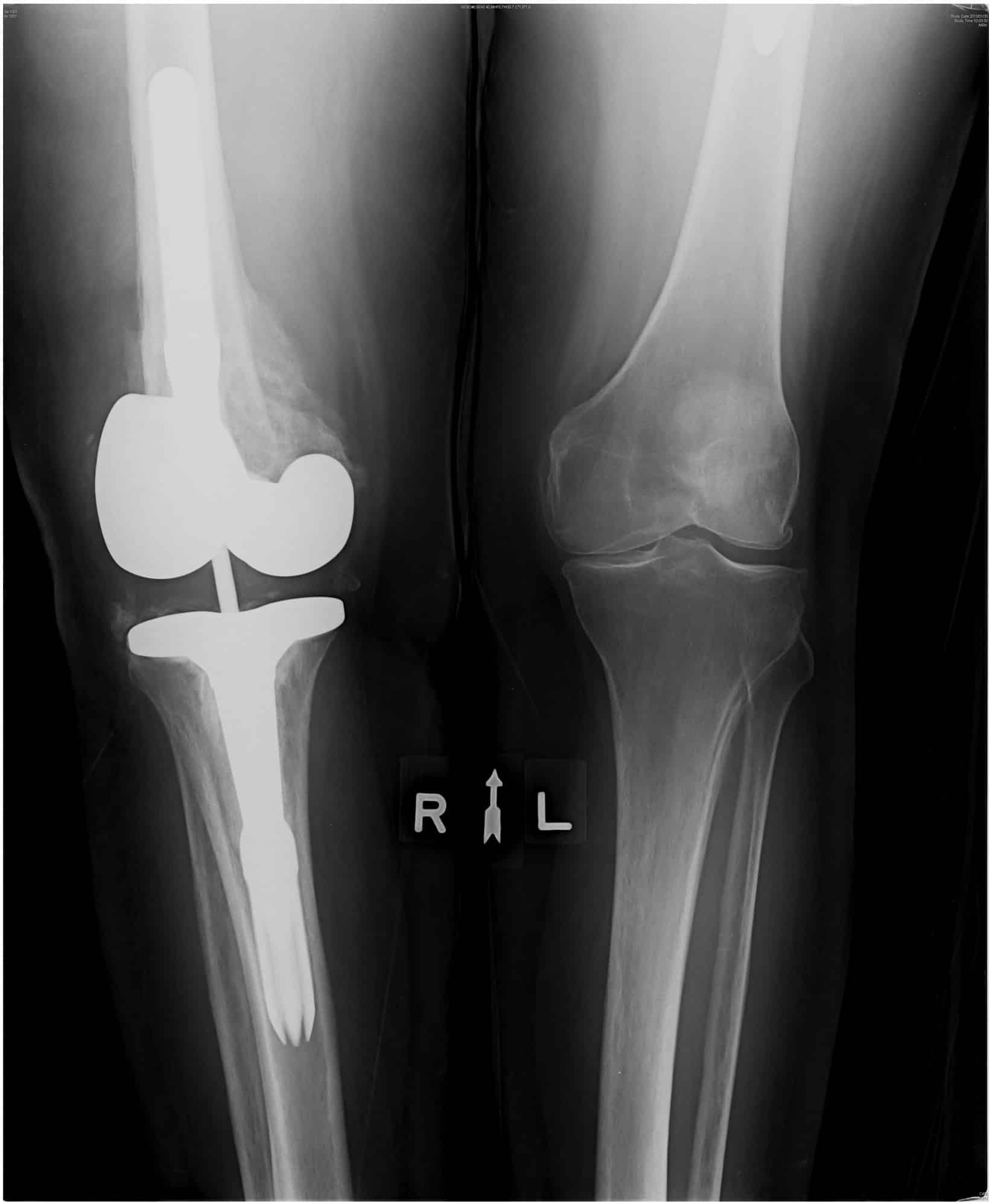 Treatment of infected nonunion total knee arthroplasty periprosthetic ...