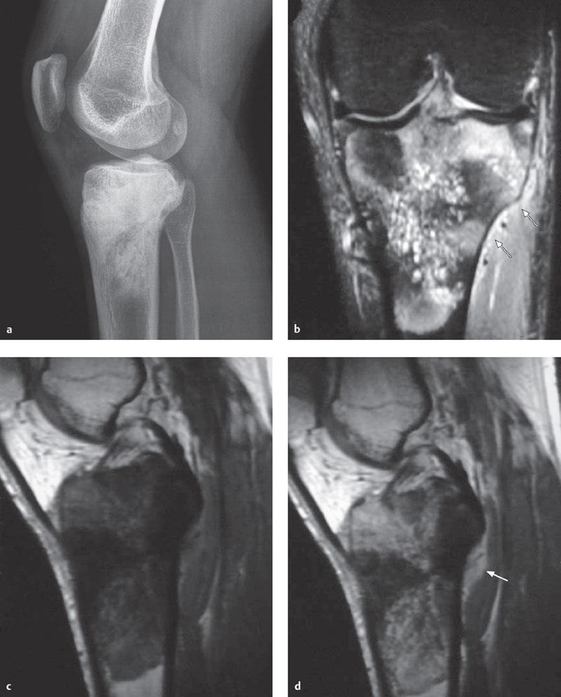 Tumors and Tumorlike Lesions of the Knee Joint