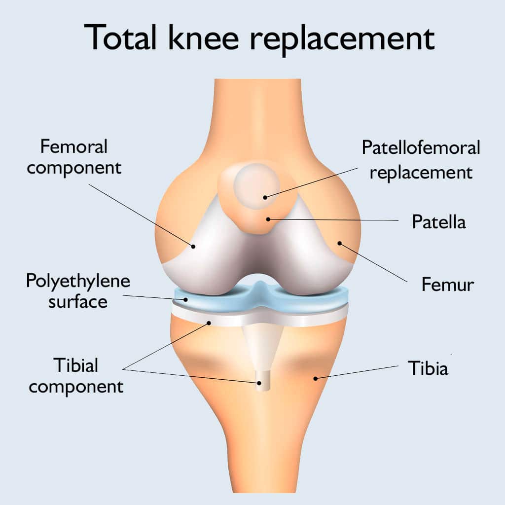 Types of knee prostheses
