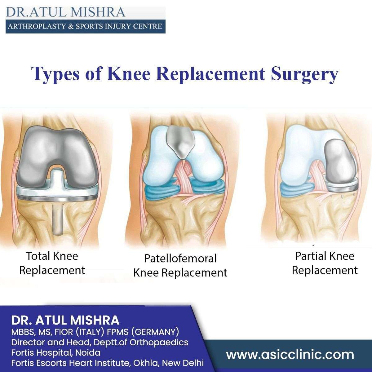 Types of Knee Replacement Surgery in 2020
