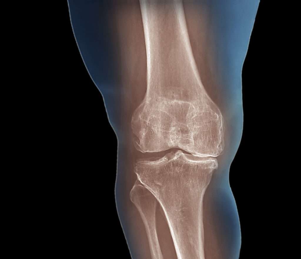 Viscosupplementation for Knee Osteoarthritis ...