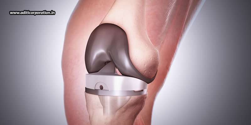 Walkthrough Of A Total Knee Replacement Surgery