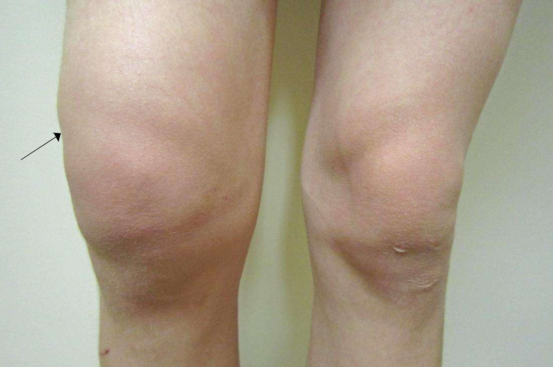 Water On The Knee (Knee Effusion): Treatment, symptoms ...