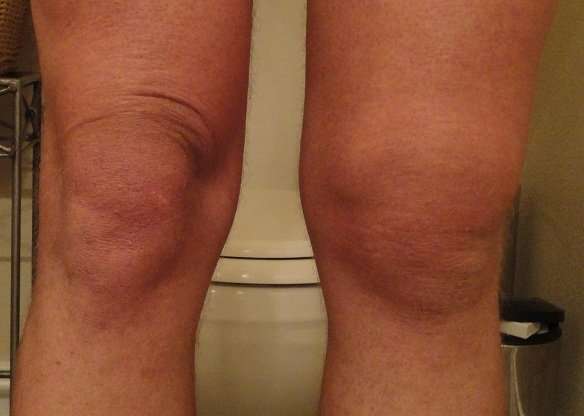 Water On The Knee Treatment, And The Best Lifestyle To ...