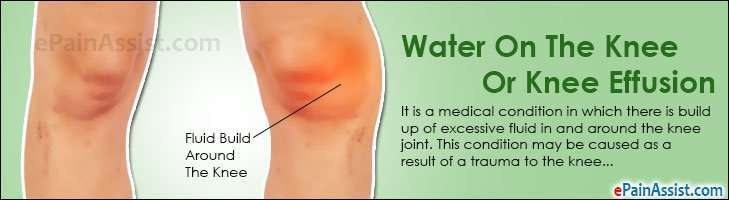 Water On The Knee: Treatment, Home Remedies, Prevention ...