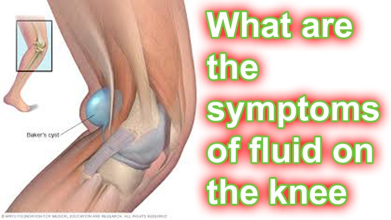 What are the symptoms of fluid on the knee?