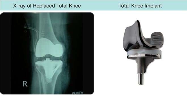 What are the types of Total Knee Replacement?