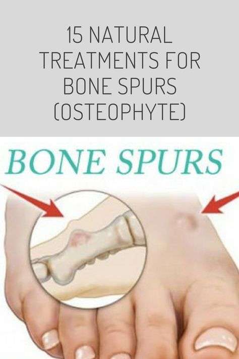 What can you do for bone spurs in your neck? Bone spurs in ...