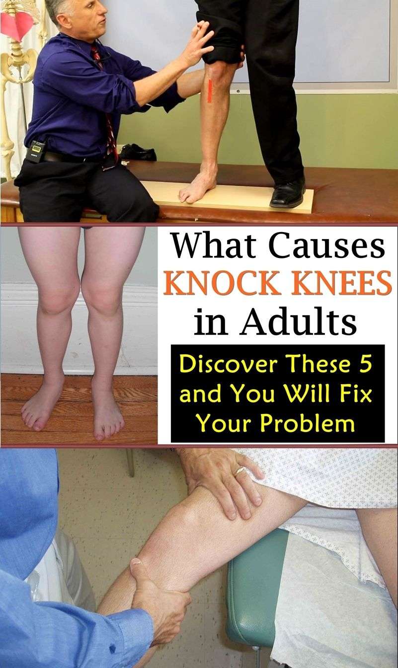 What causes Knock Knees in Adults?