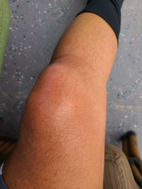 What Does It Mean If My Knee Is Swollen?