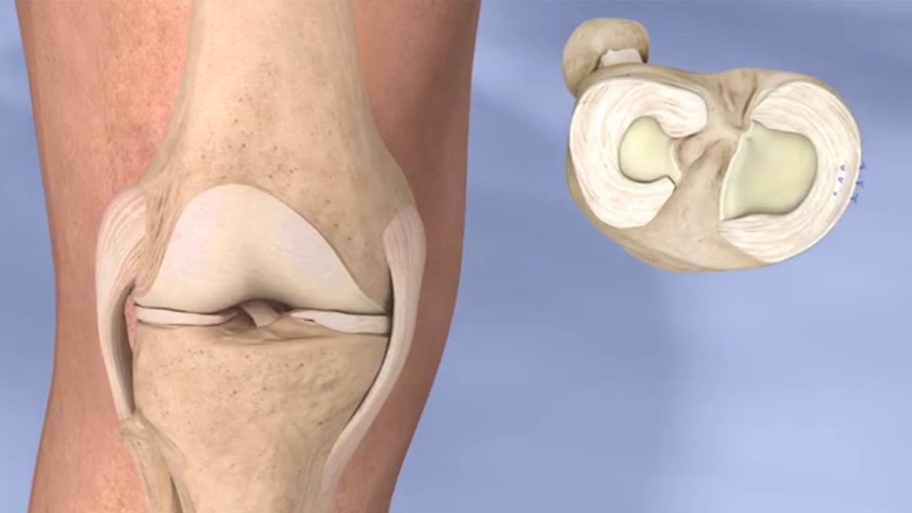 What happens if you leave a torn meniscus untreated ...