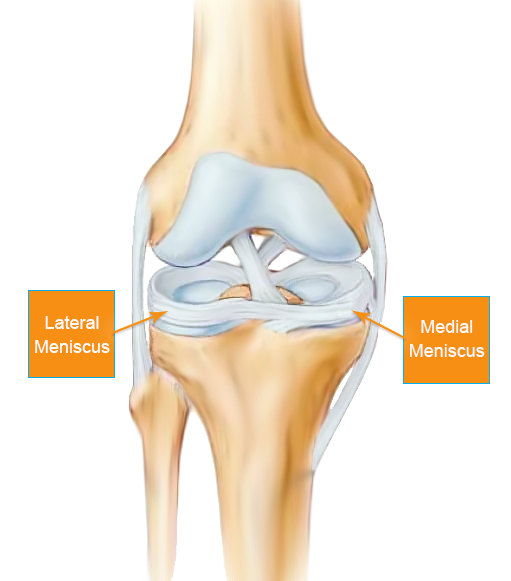 What is a Torn Meniscus (Meniscus Tear)