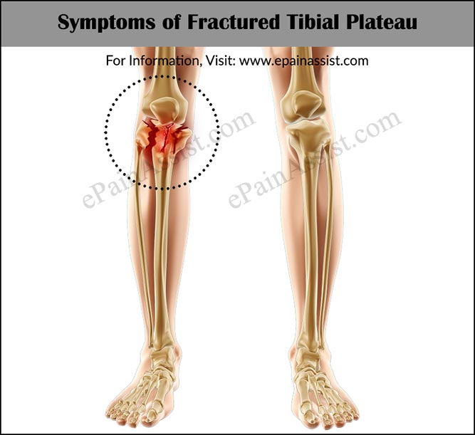 What is Fractured Tibial Plateau or Tibial Plateau Fracture?