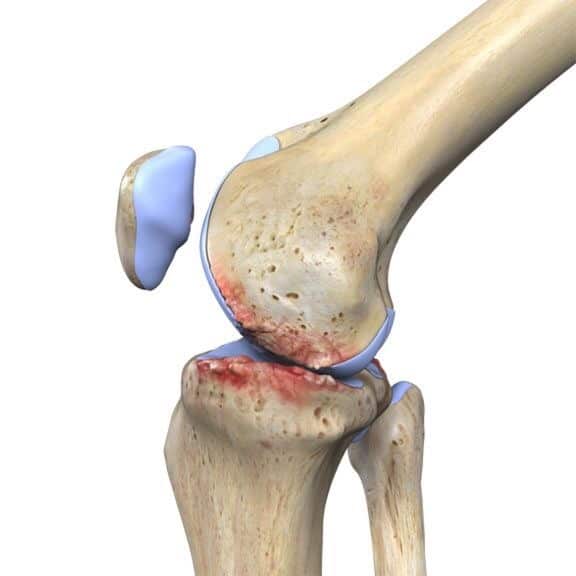 What is the best treatment for the knee joint?