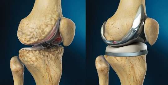 What is Total Knee Replacement?