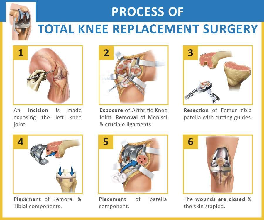 What is Total Knee Replacement (TKR) ?? â All The Pros ...