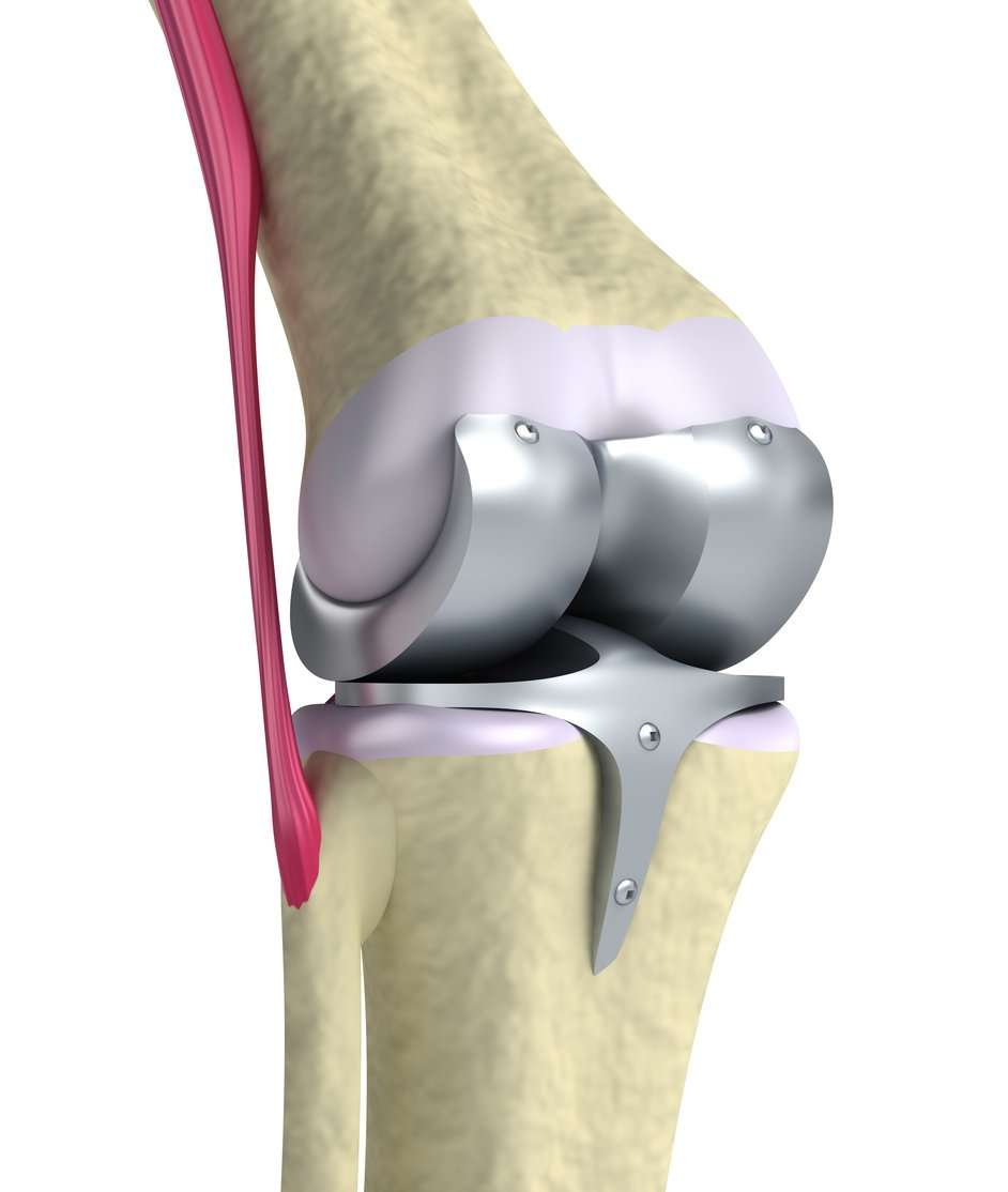 What To Expect After Having a Total Knee Replacement
