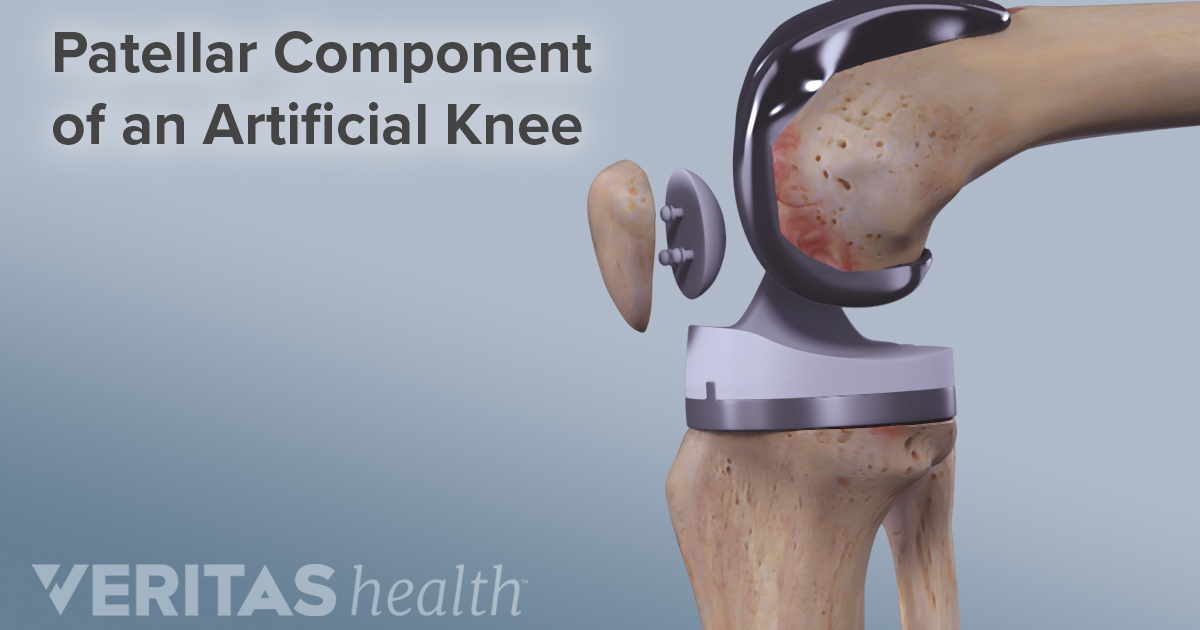 What to Expect After Knee Replacement