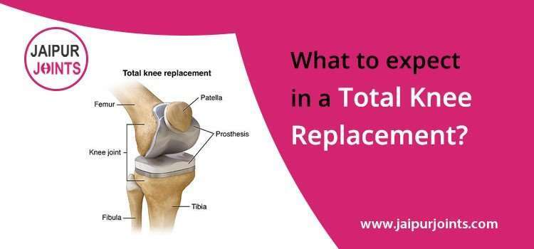 What to expect in a total knee replacement?
