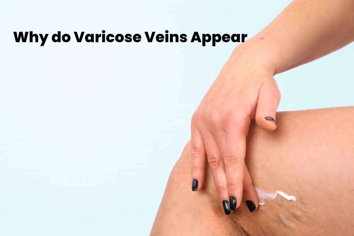 Why do Varicose Veins Appear