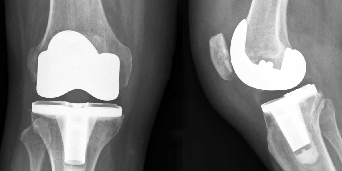 Why Wait For A Total Knee Replacement