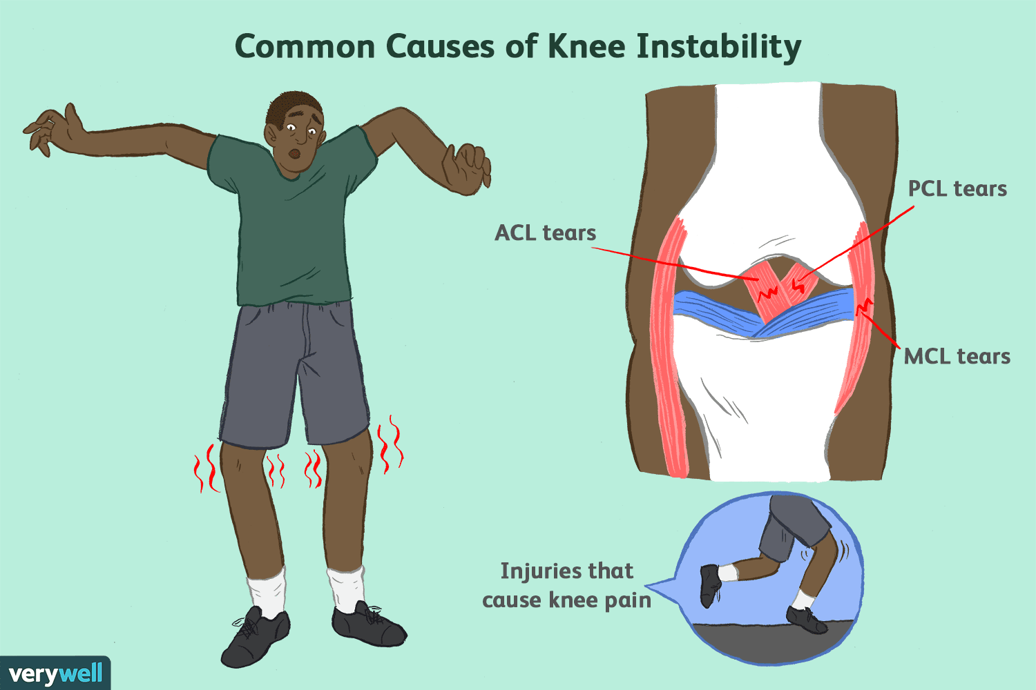 Why You Feel Your Knee Giving Out