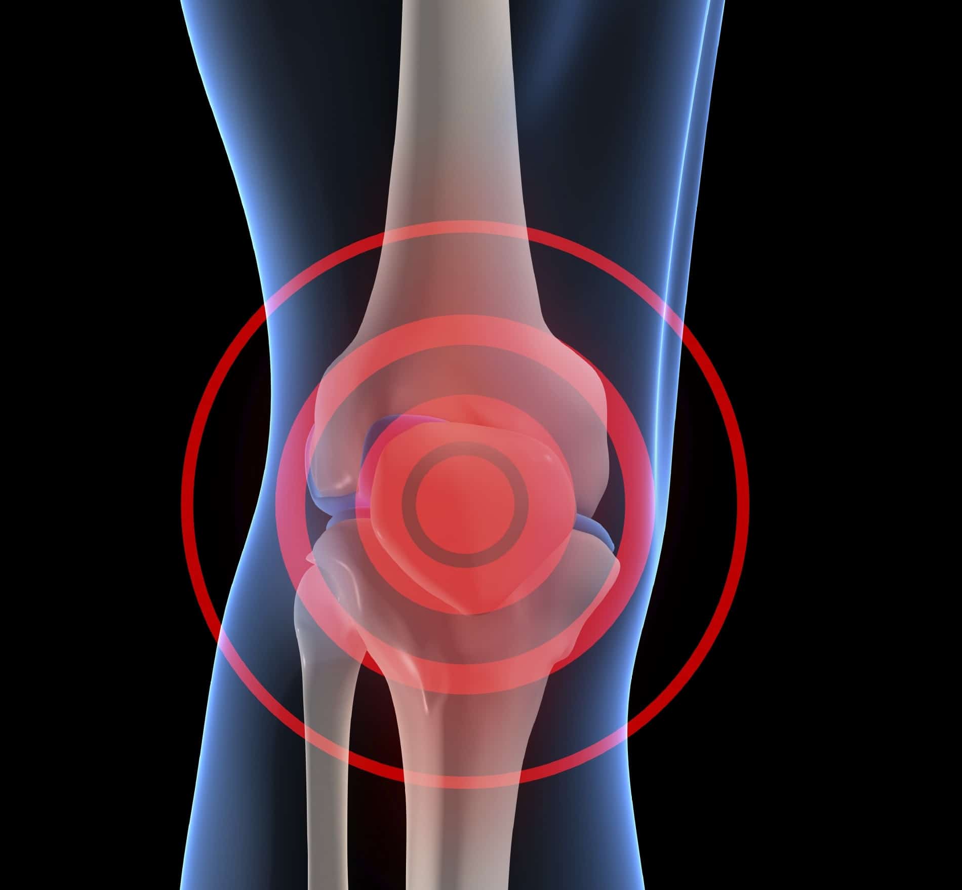 Women Who Drink Milk May Slow Knee Osteoarthritis