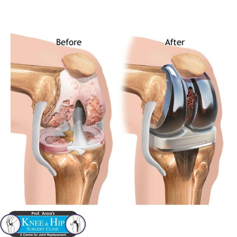 You can have knee replacement surgeon Delhi at an ...